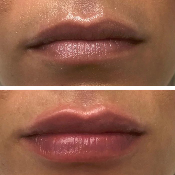 before & after photo of Lip Filler