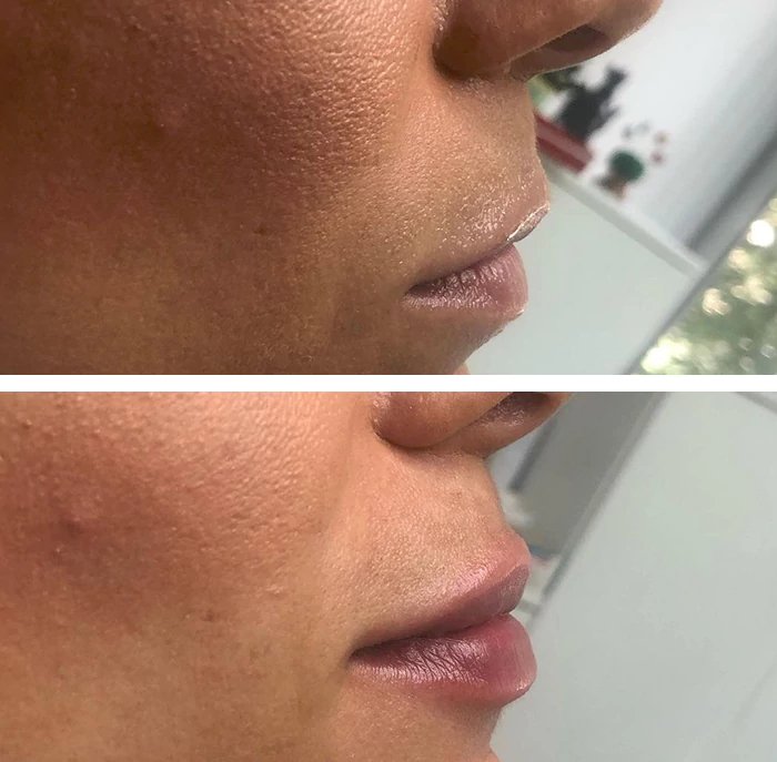 before & after photo of Lip Filler