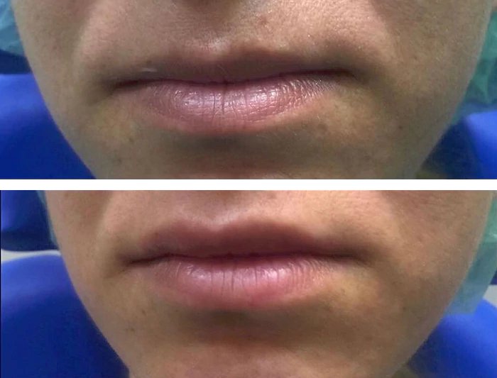 before & after photo of Lip Filler