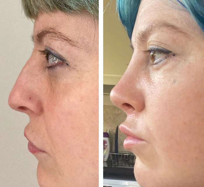 before & after photo of Rhinoplasty