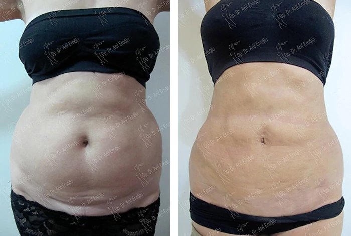 before & after photo of Liposuction