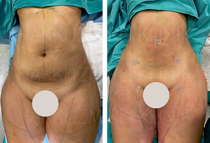 before & after photo of Brazilian Butt Lift