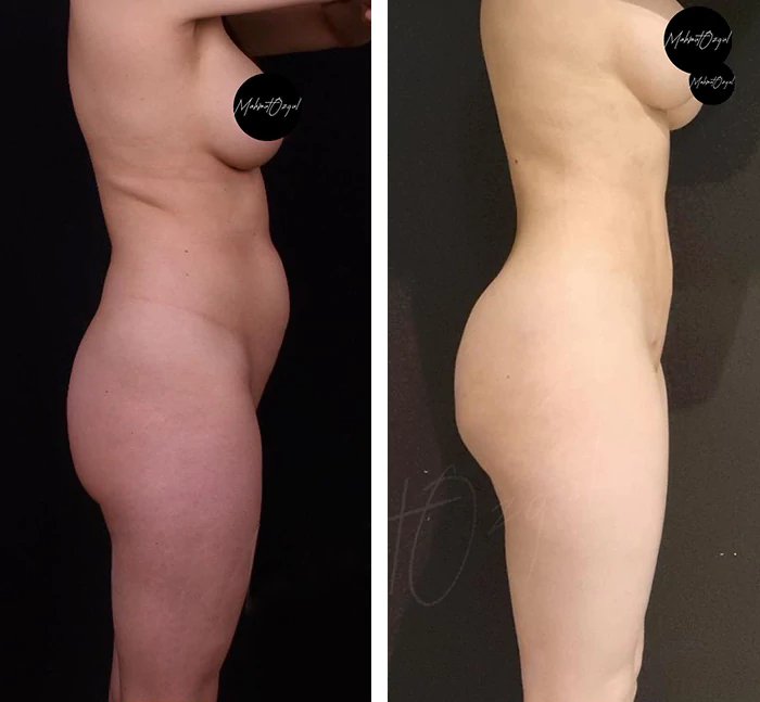 before & after photo of عملية تجميل الأنف