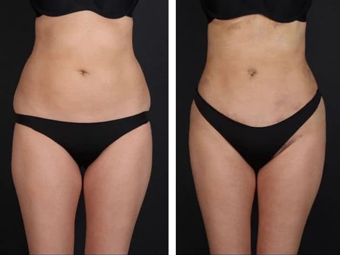 before & after photo of Tummy Tuck