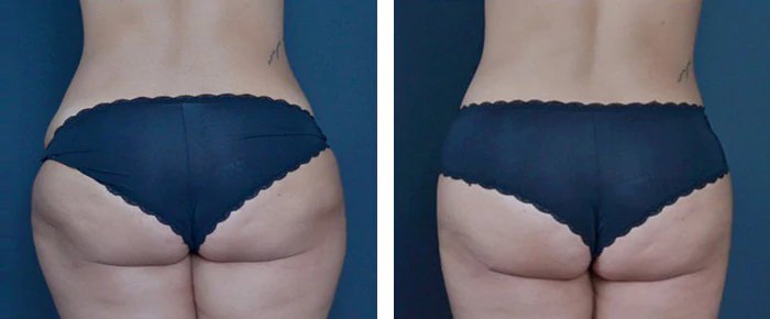 before & after photo of Liposuction