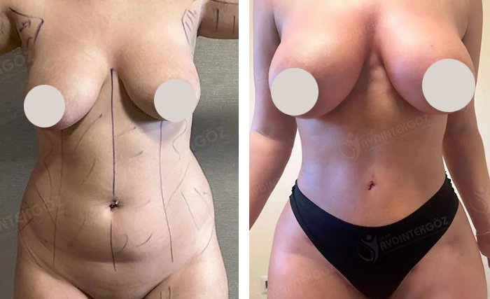 before & after photo of Abdominal Etching