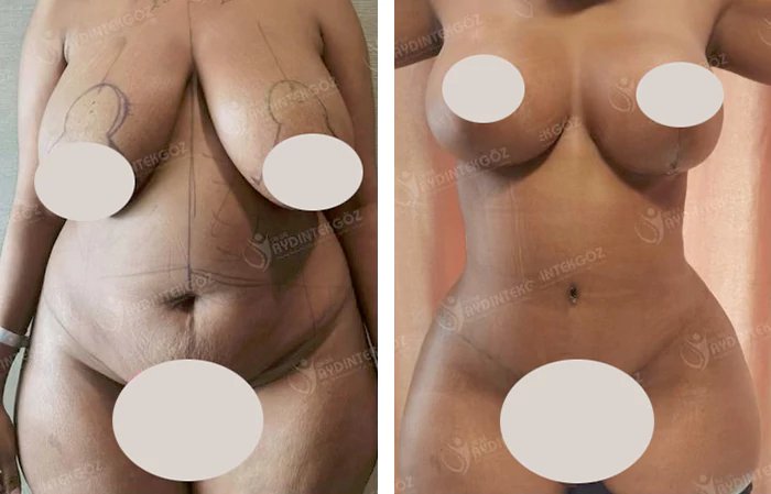 before & after photo of Abdominal Etching