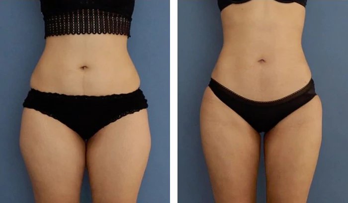 before & after photo of Liposuction