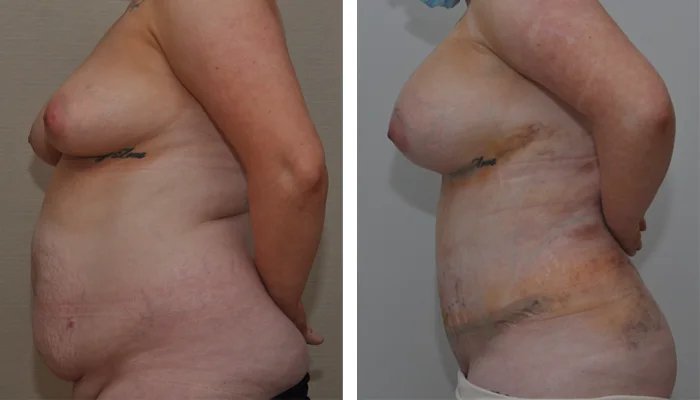 before & after photo of Tummy Tuck