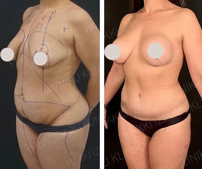 before & after photo of Brazilian Butt Lift