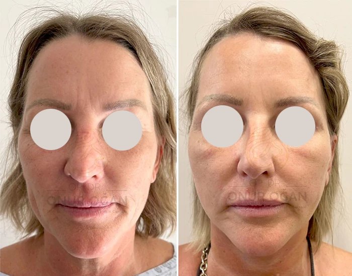 before & after photo of facelift