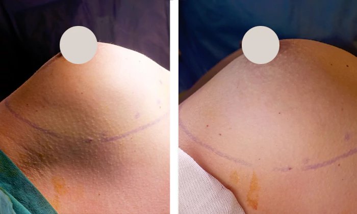 before & after photo of Inverted Nipple Correction