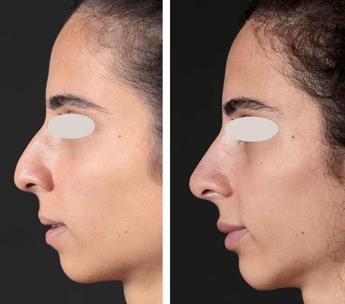 before & after photo of Nose Filler