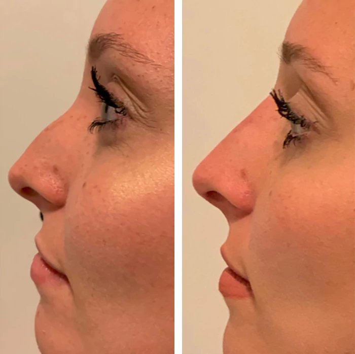 before & after photo of Nose Filler