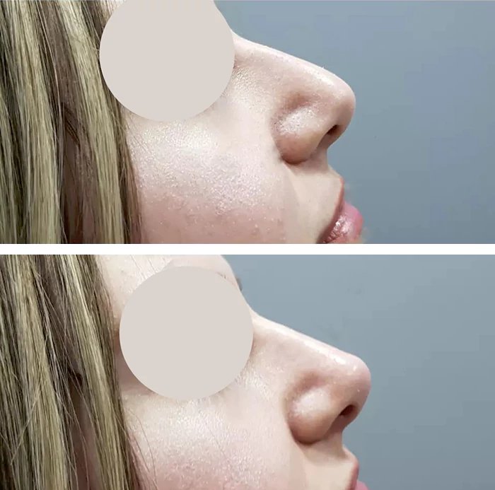 before & after photo of Nose Filler