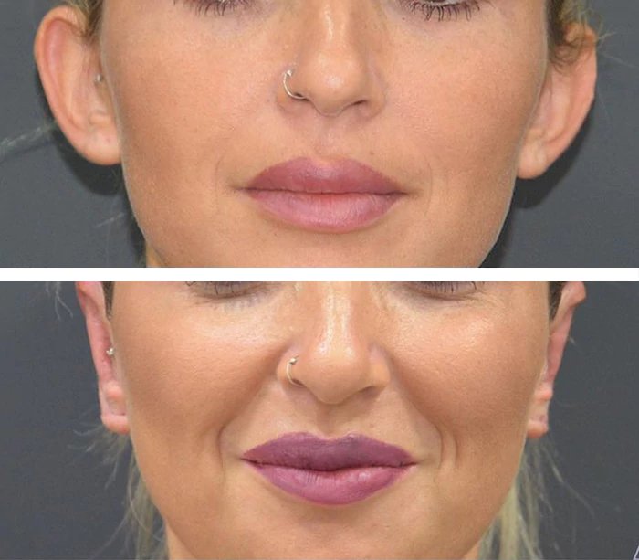 before & after photo of عملية تجميل الأنف