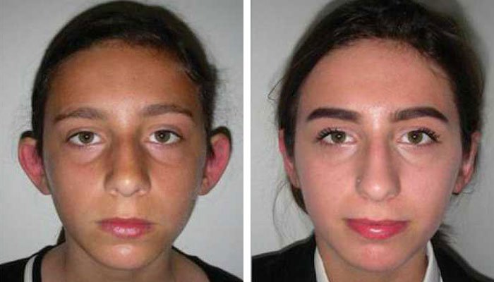 before & after photo of otoplasty