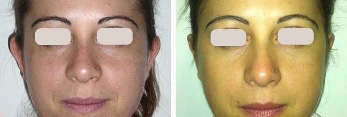 before & after photo of عملية تجميل الأذن