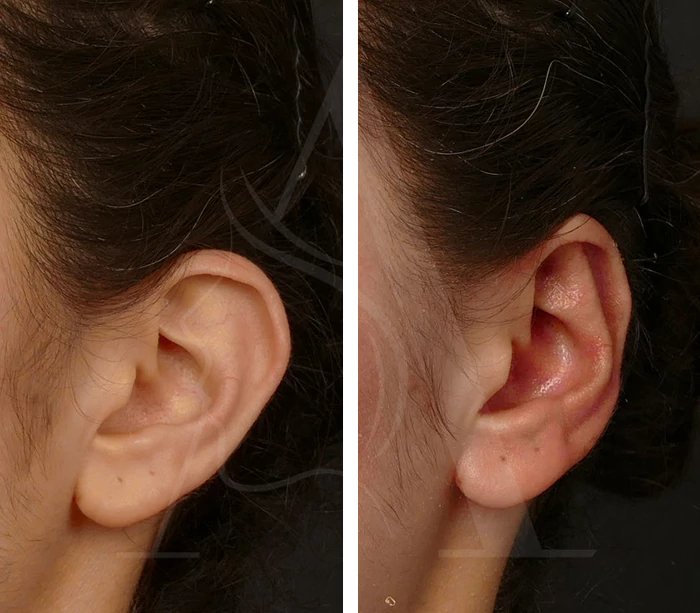 before & after photo of Rhinoplasty