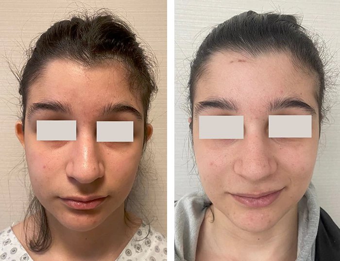 before & after photo of عملية تجميل الأذن