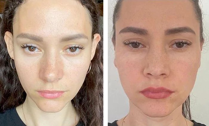 before & after photo of عملية تجميل الأذن