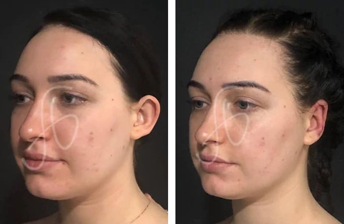 before & after photo of عملية تجميل الأذن