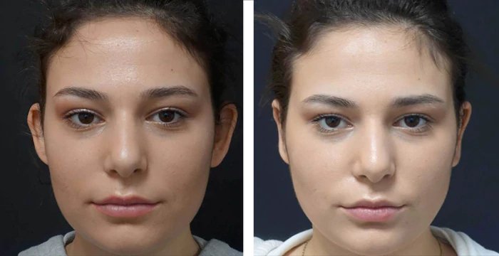 before & after photo of عملية تجميل الأذن