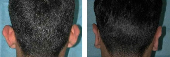 before & after photo of عملية تجميل الأذن