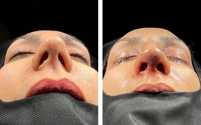 before & after photo of Rhinoplasty