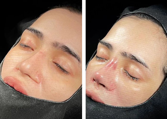 before & after photo of عملية تجميل الأنف