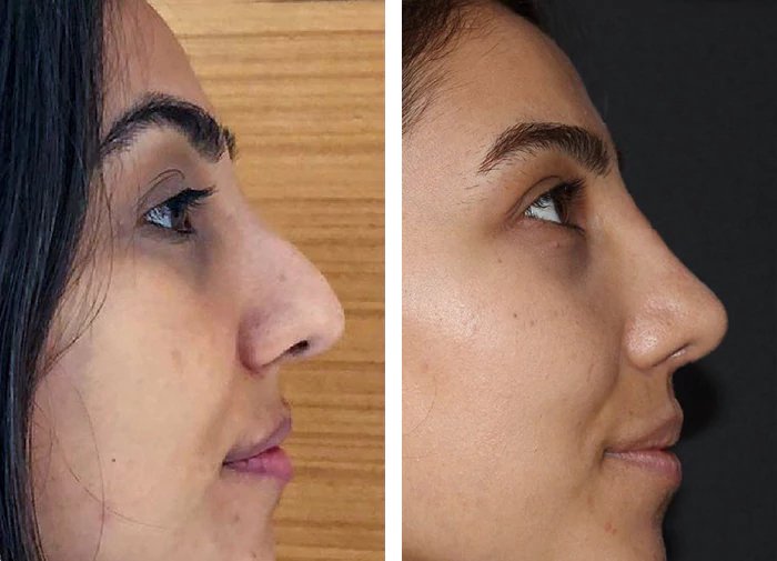 before & after photo of عملية تجميل الأنف