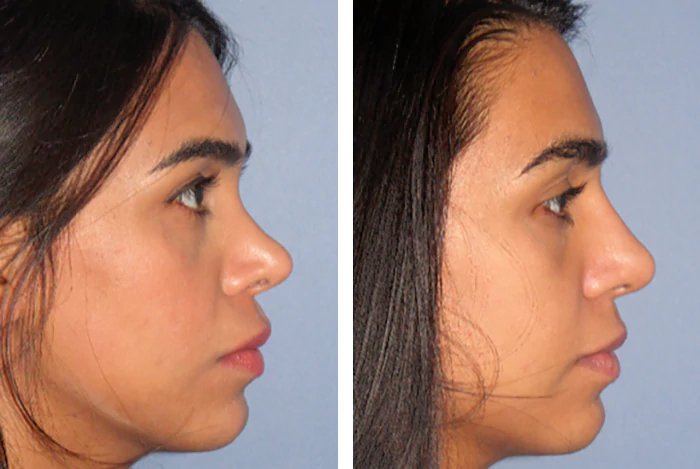 before & after photo of Rhinoplasty