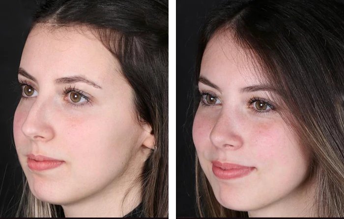 before & after photo of Rhinoplasty