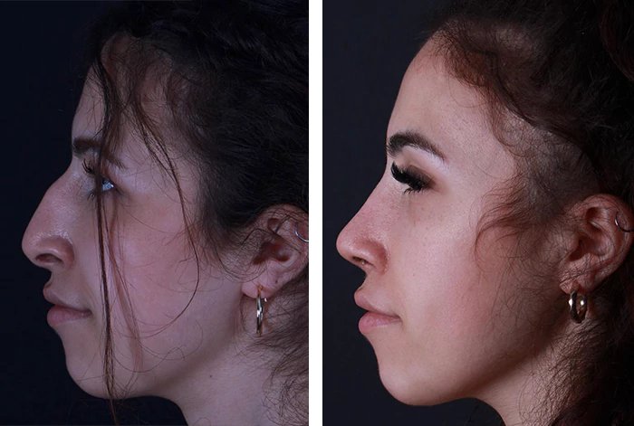 before & after photo of Rhinoplasty