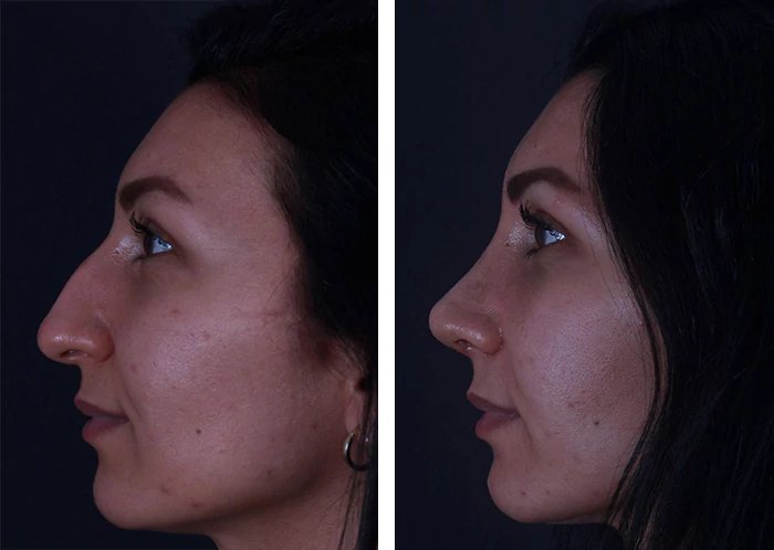 before & after photo of Rhinoplasty