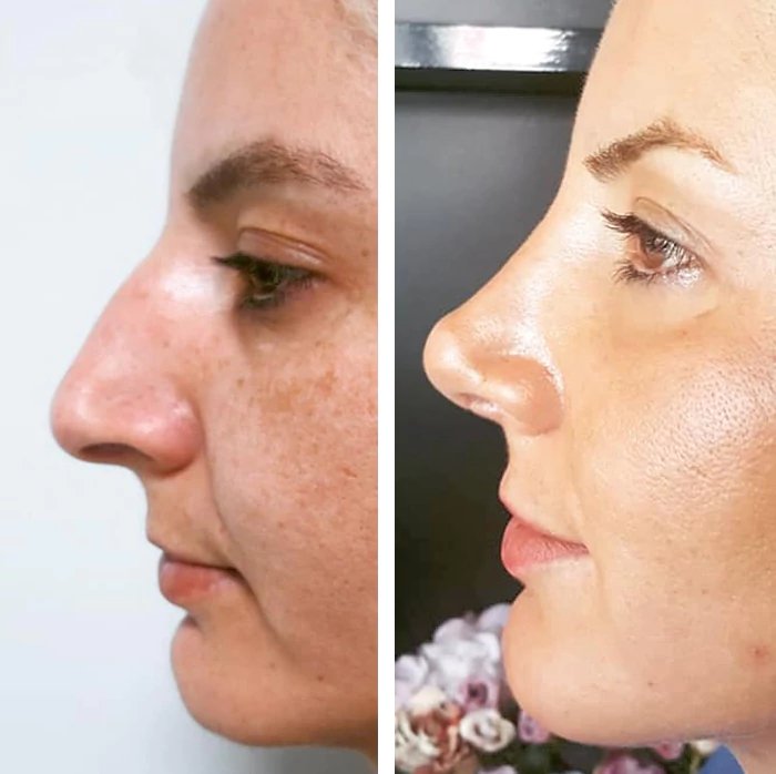 before & after photo of Botox & other Injectable Toxins