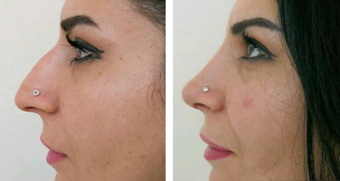 before & after photo of Botox & other Injectable Toxins