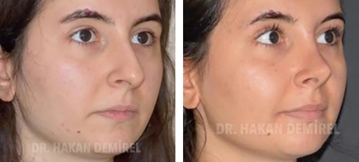 before & after photo of Rhinoplasty