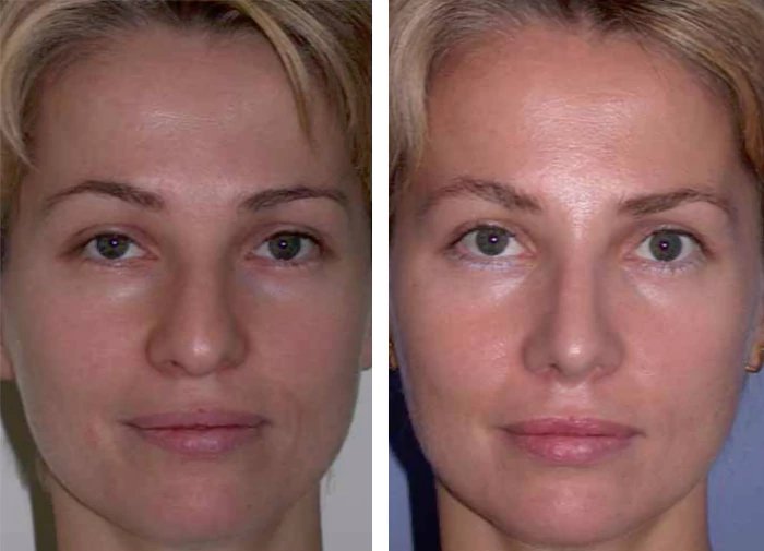 before & after photo of Rhinoplasty