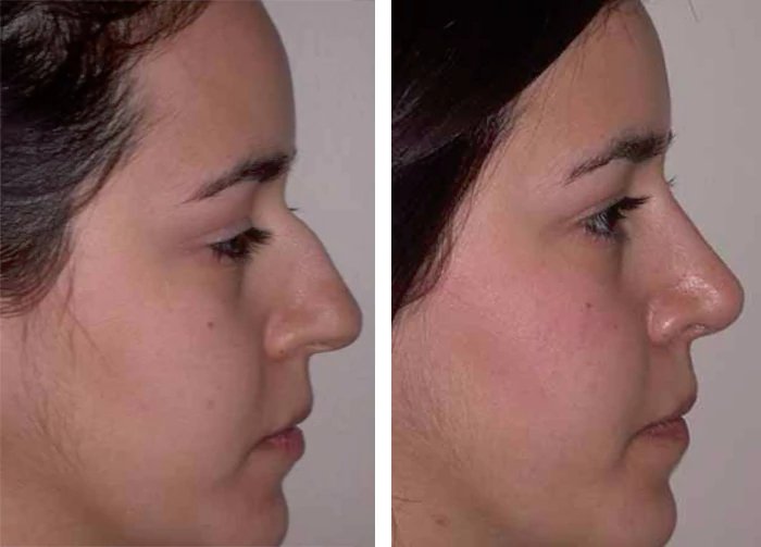 before & after photo of Rhinoplasty