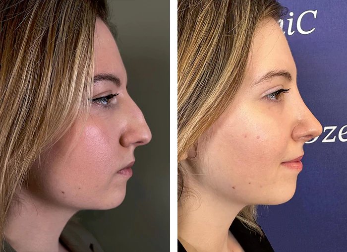 before & after photo of Rhinoplasty