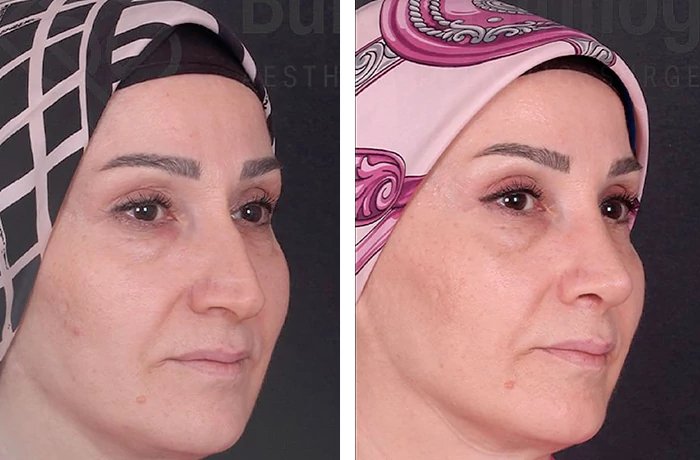 before & after photo of عملية تجميل الأنف