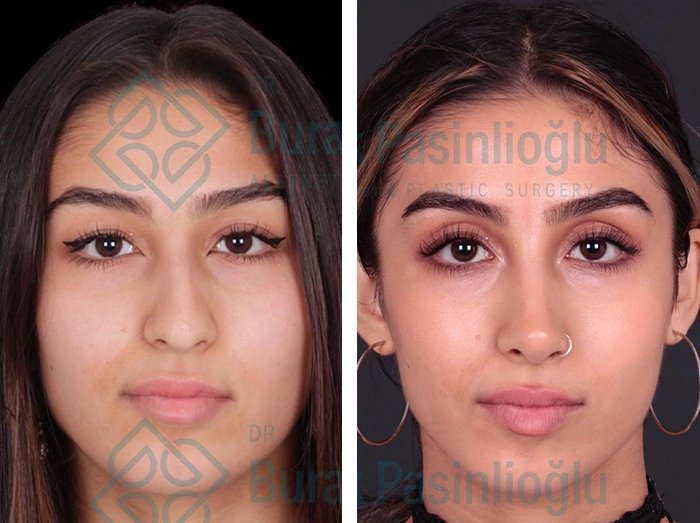 before & after photo of عملية تجميل الأنف