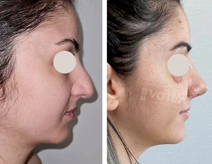 before & after photo of Rhinoplasty