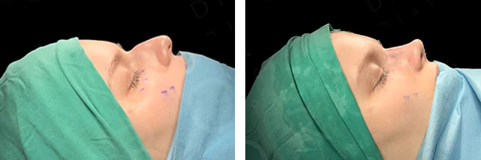 before & after photo of Tummy Tuck