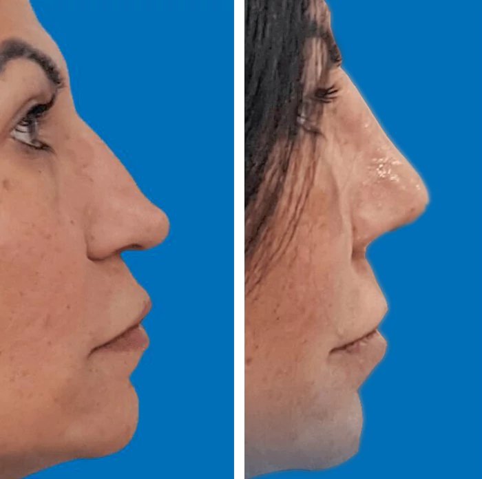 before & after photo of Rhinoplasty