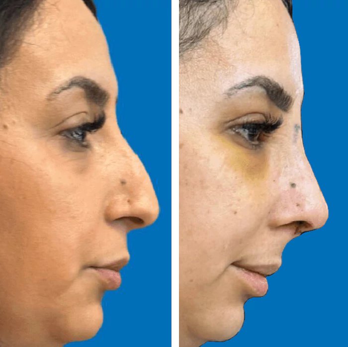 before & after photo of عملية تجميل الأنف