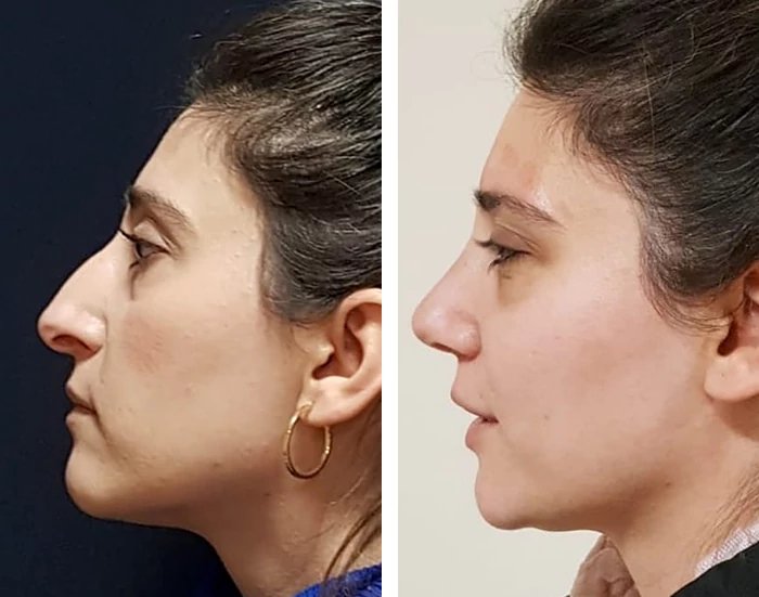 before & after photo of Rhinoplasty