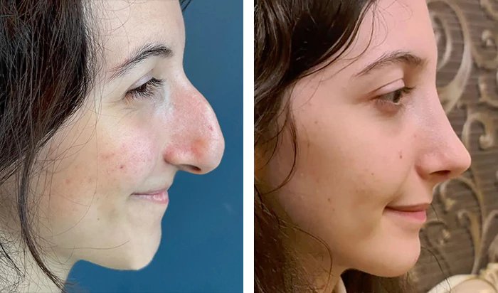 before & after photo of Rhinoplasty