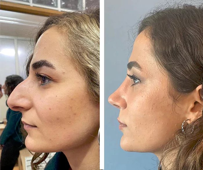 before & after photo of Rhinoplasty